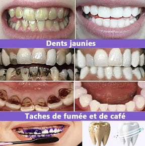 V34 Purple Teeth Whitening